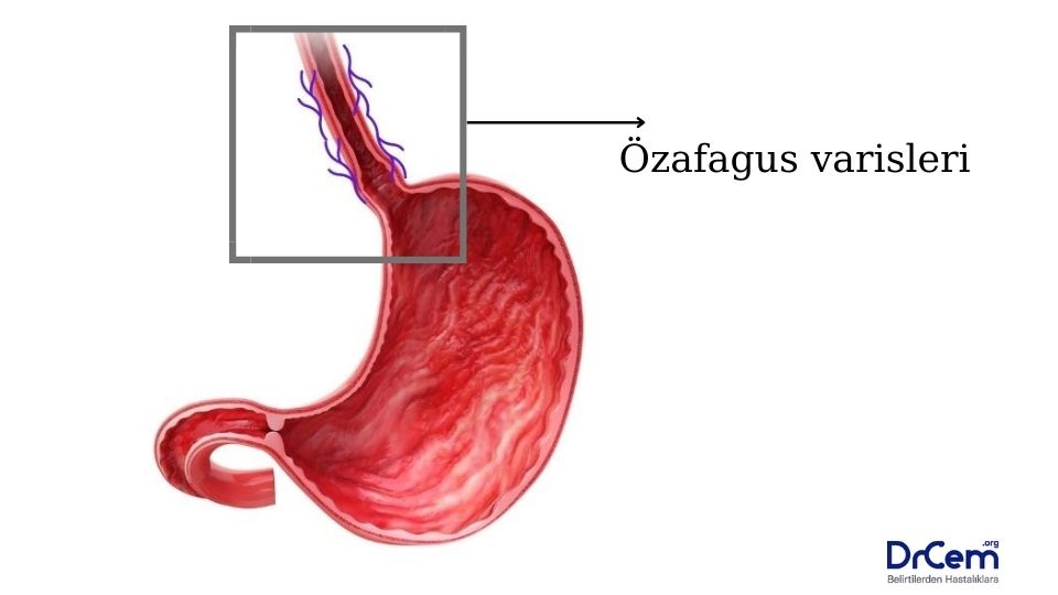 Özafagus varisleri görseli - DrCem hastalık rehberi